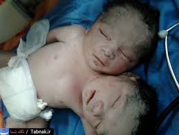 Two-headed baby born in Khuzestan, Iran